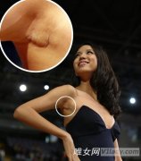 2007年世界小姐张梓琳腋下疤痕是怎么回事？