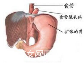 反流性食管炎症状有哪些表现？